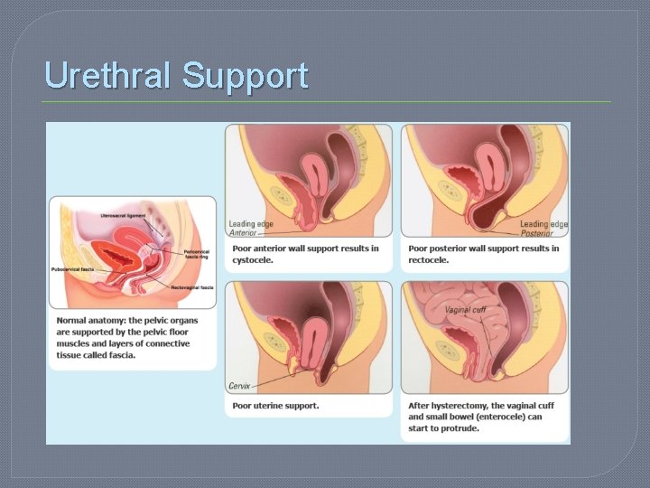 Urethral Support 