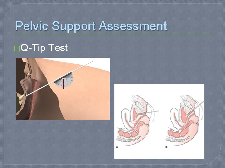 Pelvic Support Assessment �Q-Tip Test 