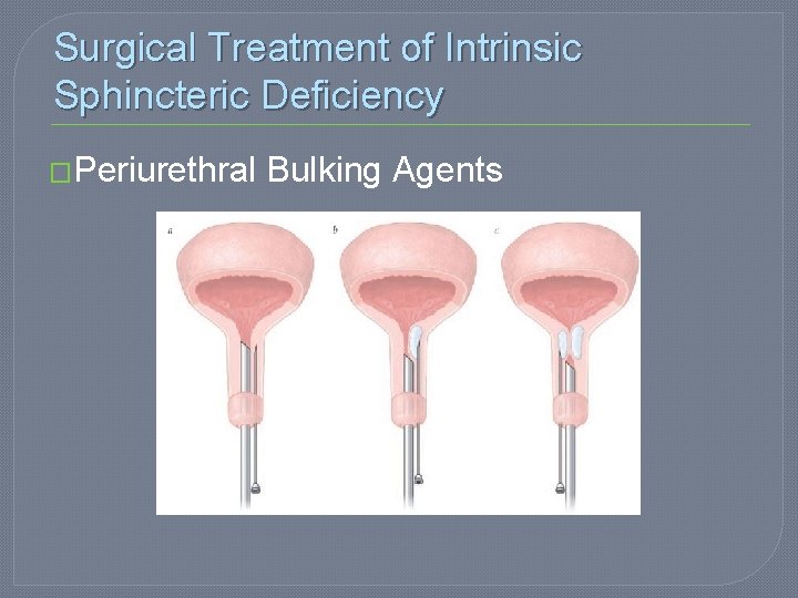 Surgical Treatment of Intrinsic Sphincteric Deficiency �Periurethral Bulking Agents 