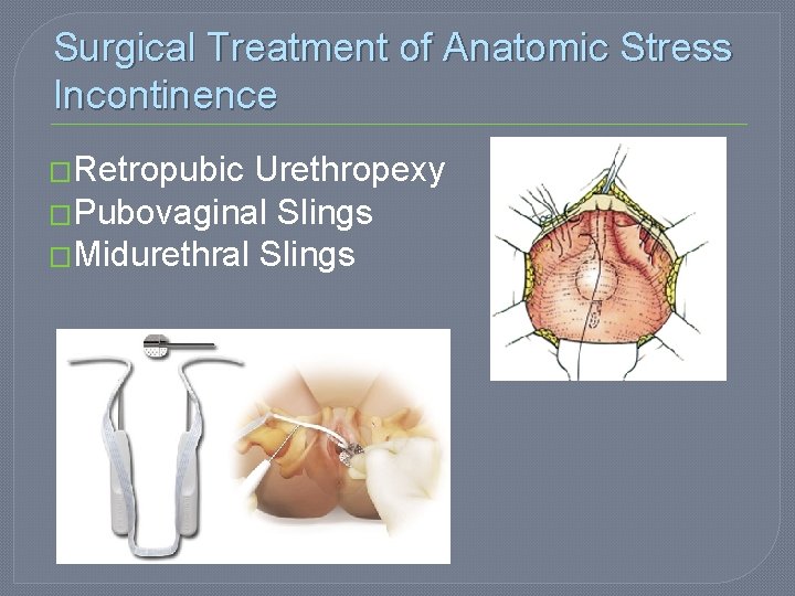 Surgical Treatment of Anatomic Stress Incontinence �Retropubic Urethropexy �Pubovaginal Slings �Midurethral Slings 