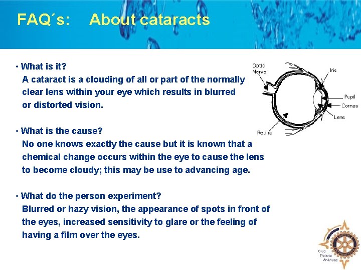 FAQ´s: About cataracts • What is it? A cataract is a clouding of all