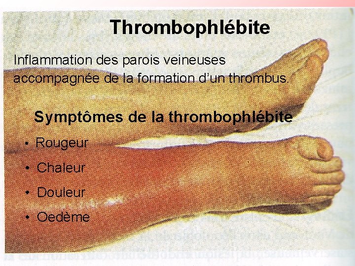 Thrombophlébite Inflammation des parois veineuses accompagnée de la formation d’un thrombus. Symptômes de la