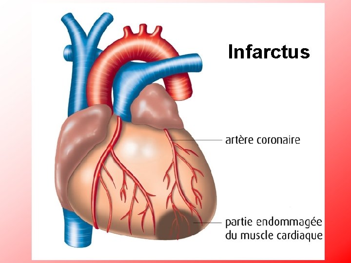 Infarctus 