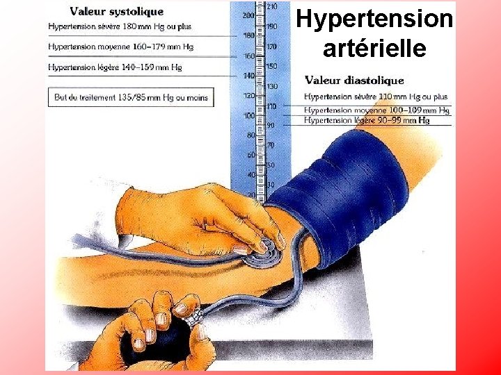 Hypertension artérielle 