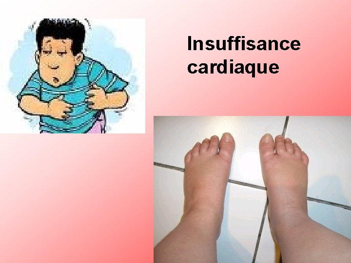 Insuffisance cardiaque 