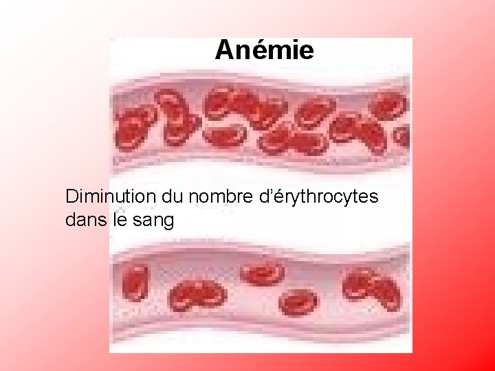 Anémie Diminution du nombre d’érythrocytes dans le sang 