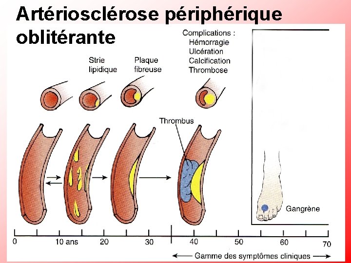 Artériosclérose périphérique oblitérante 