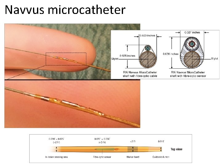 Navvus microcatheter 