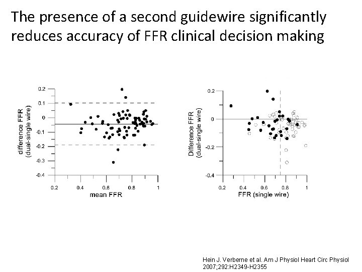 The presence of a second guidewire significantly reduces accuracy of FFR clinical decision making