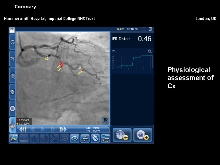 Coronary Hammersmith Hospital, Imperial College NHS Trust London, UK Physiological assessment of Cx 