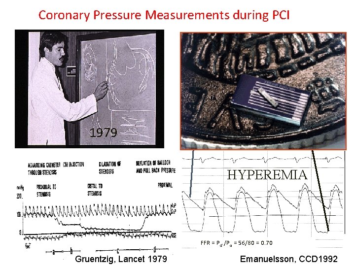 Coronary Pressure Measurements during PCI 1979 Pa 1992 Pd HYPEREMIA FFR = Pd /Pa