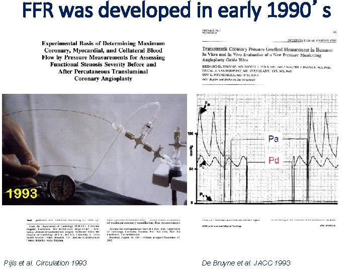 FFR was developed in early 1990’s Pijls et al. Circulation 1993 De Bruyne et