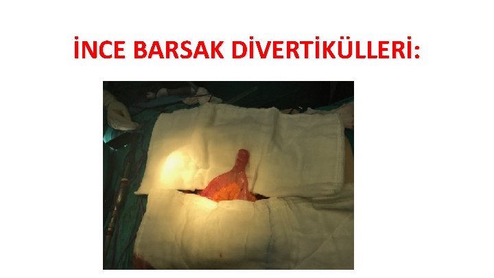 İNCE BARSAK DİVERTİKÜLLERİ: 