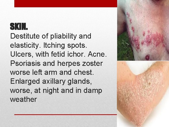 SKIN. Destitute of pliability and elasticity. Itching spots. Ulcers, with fetid ichor. Acne. Psoriasis