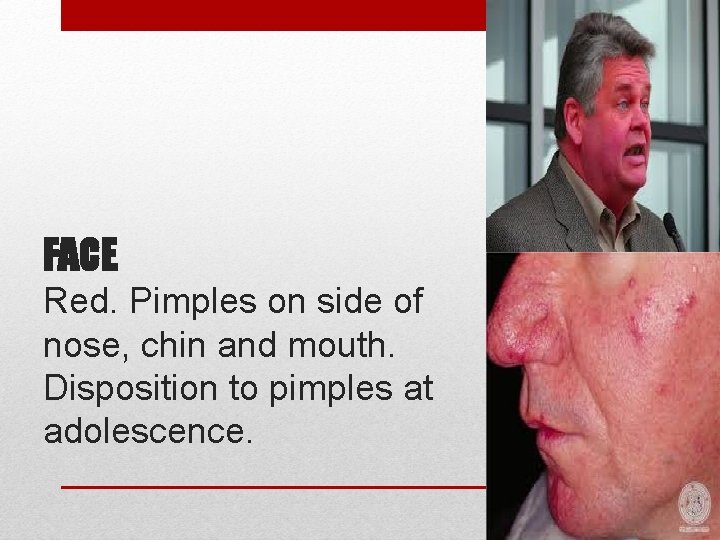 FACE Red. Pimples on side of nose, chin and mouth. Disposition to pimples at