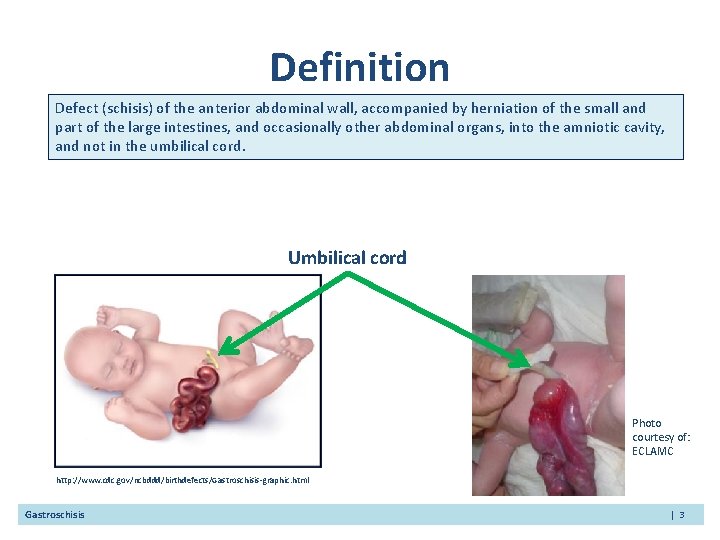 Definition Defect (schisis) of the anterior abdominal wall, accompanied by herniation of the small