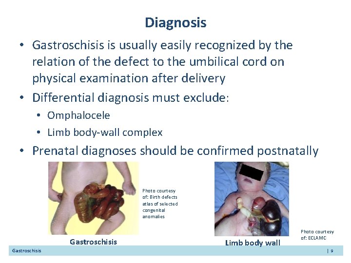 Diagnosis • Gastroschisis is usually easily recognized by the relation of the defect to