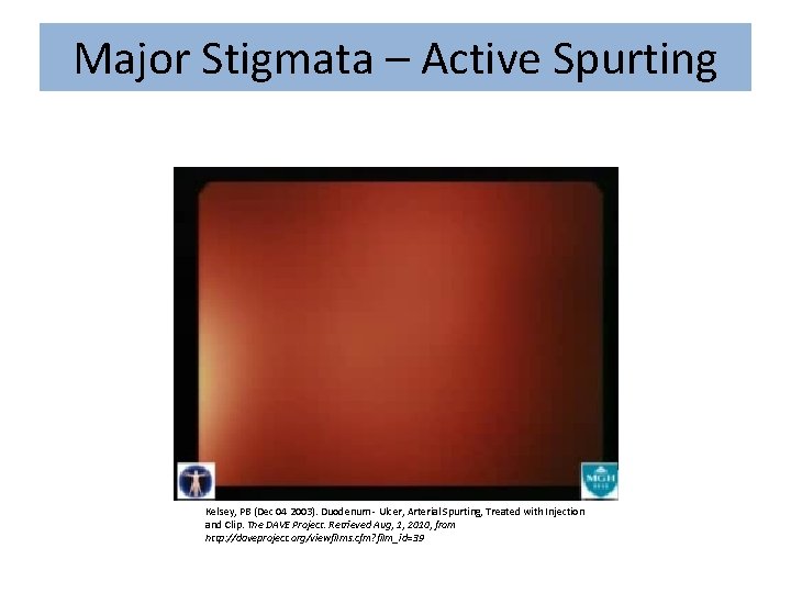 Major Stigmata – Active Spurting Kelsey, PB (Dec 04 2003). Duodenum - Ulcer, Arterial