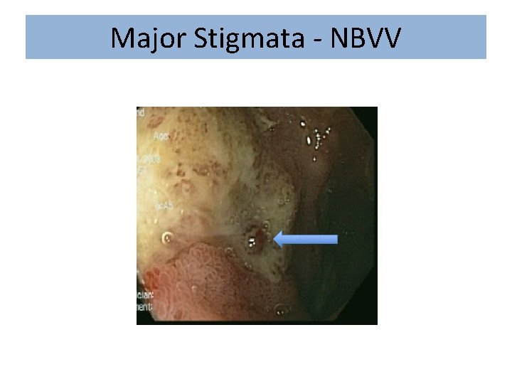 Major Stigmata - NBVV 