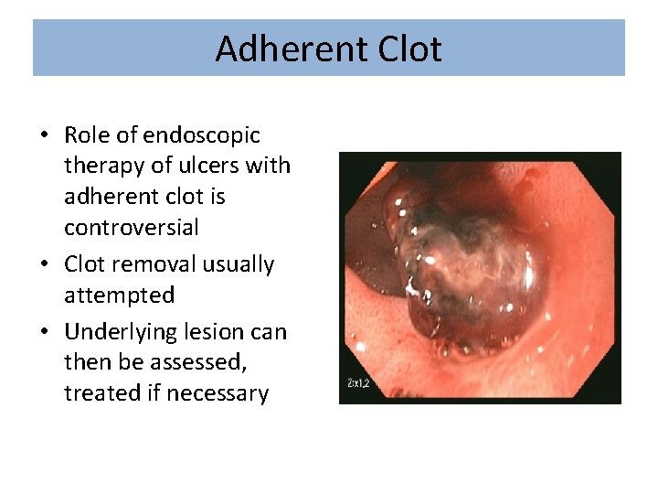 Adherent Clot • Role of endoscopic therapy of ulcers with adherent clot is controversial