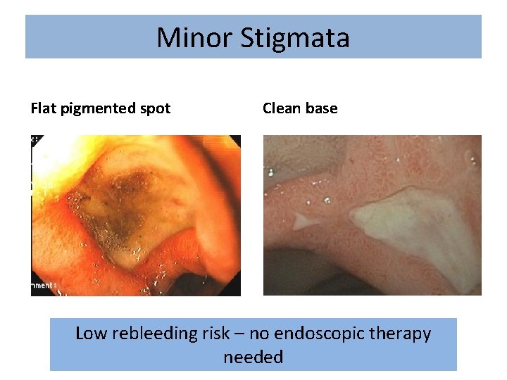 Minor Stigmata Flat pigmented spot Clean base Low rebleeding risk – no endoscopic therapy