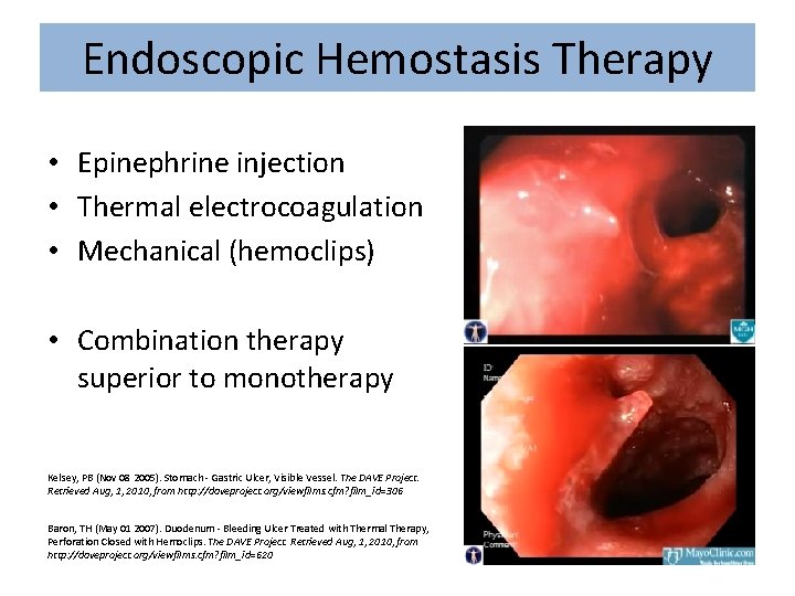 Endoscopic Hemostasis Therapy • Epinephrine injection • Thermal electrocoagulation • Mechanical (hemoclips) • Combination