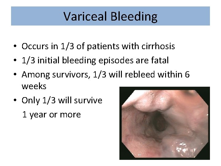 Variceal Bleeding • Occurs in 1/3 of patients with cirrhosis • 1/3 initial bleeding