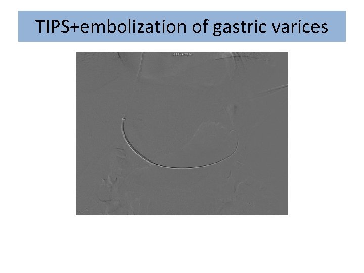 TIPS+embolization of gastric varices 