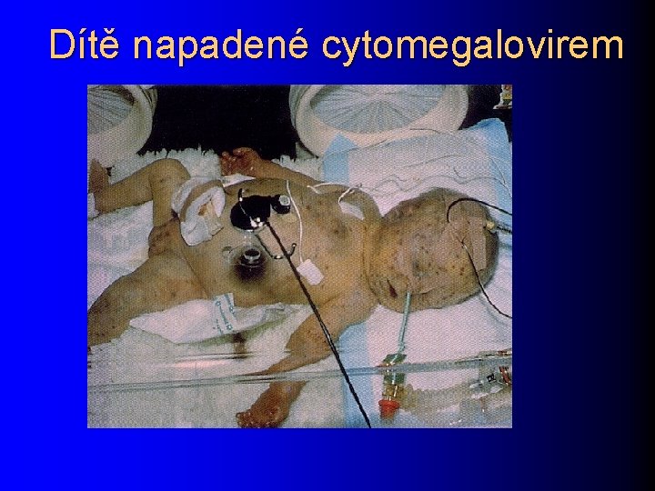 Dítě napadené cytomegalovirem 