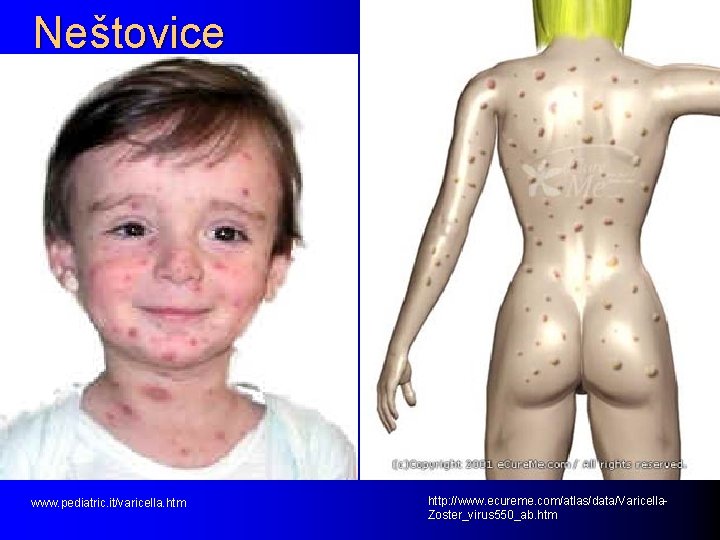 Neštovice www. pediatric. it/varicella. htm http: //www. ecureme. com/atlas/data/Varicella. Zoster_virus 550_ab. htm 