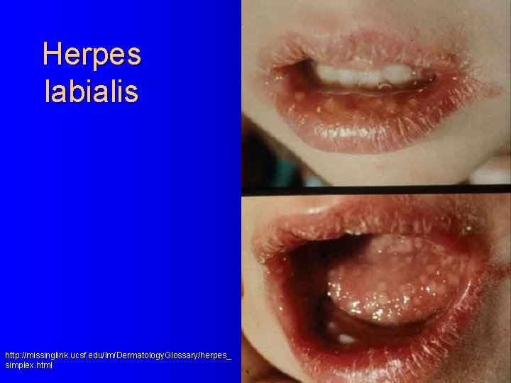 Herpes labialis http: //missinglink. ucsf. edu/lm/Dermatology. Glossary/herpes_ simplex. html 