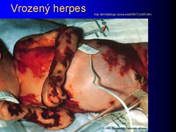 Vrozený herpes tray. dermatology. uiowa. edu/HSVCon 05. htm 