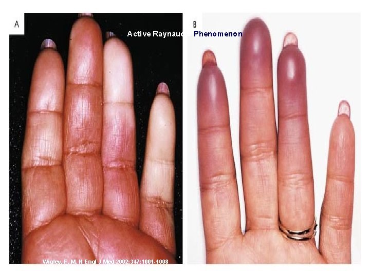 Active Raynaud's Phenomenon Wigley, F. M. N Engl J Med 2002; 347: 1001 -1008