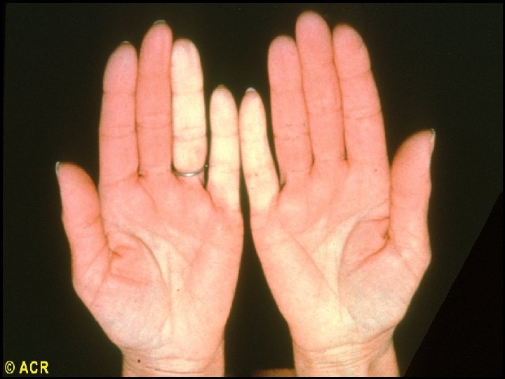 Raynaud’s phenomenon, blanching of hands 