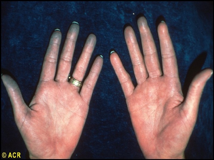 Scleroderma: Raynaud’s phenomenon, cyanosis of the hands 