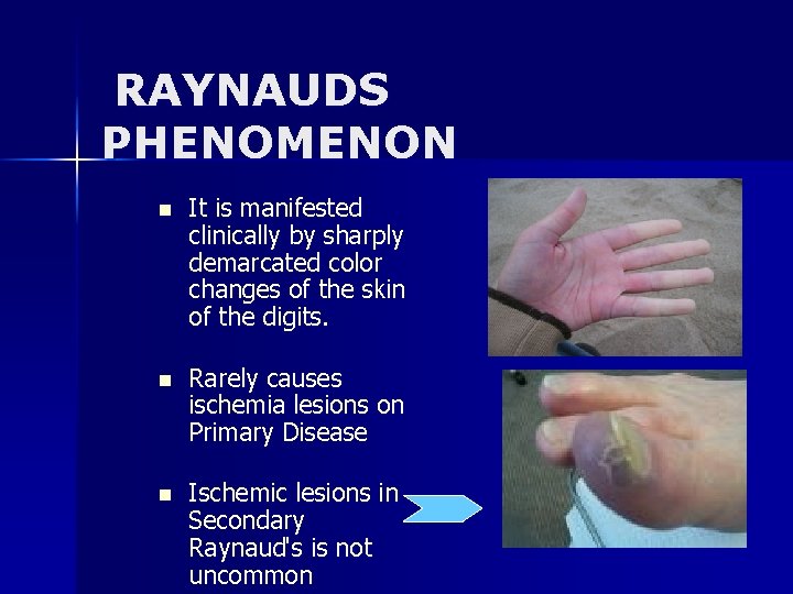 RAYNAUDS PHENOMENON n It is manifested clinically by sharply demarcated color changes of the