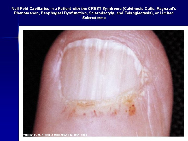 Nail-Fold Capillaries in a Patient with the CREST Syndrome (Calcinosis Cutis, Raynaud's Phenomenon, Esophageal