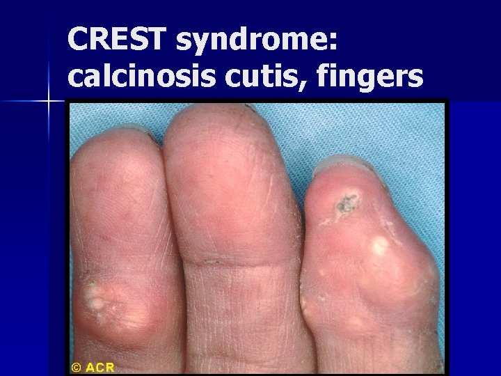 CREST syndrome: calcinosis cutis, fingers 