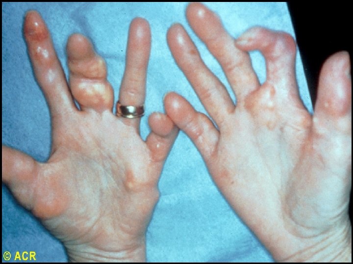 Scleroderma: calcinosis, hands 