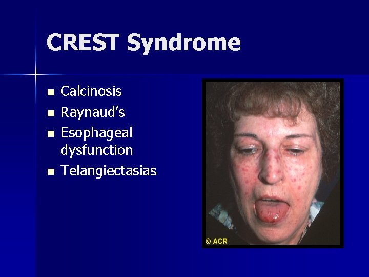 CREST Syndrome n n Calcinosis Raynaud’s Esophageal dysfunction Telangiectasias 