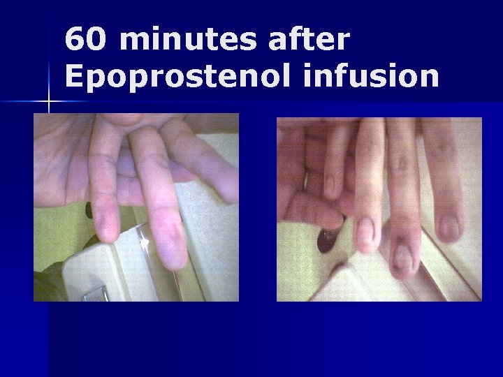 60 minutes after Epoprostenol infusion 