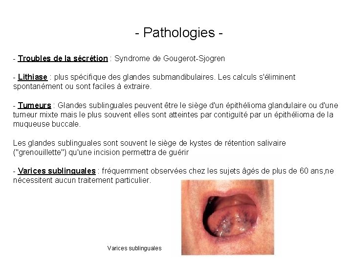 - Pathologies - Troubles de la sécrétion : Syndrome de Gougerot-Sjogren - Lithiase :
