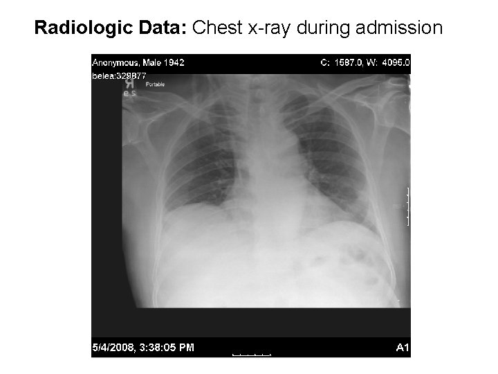 Radiologic Data: Chest x-ray during admission 