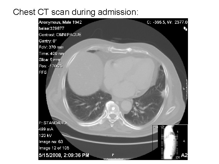 Chest CT scan during admission: 