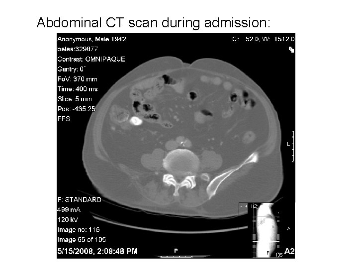 Abdominal CT scan during admission: 