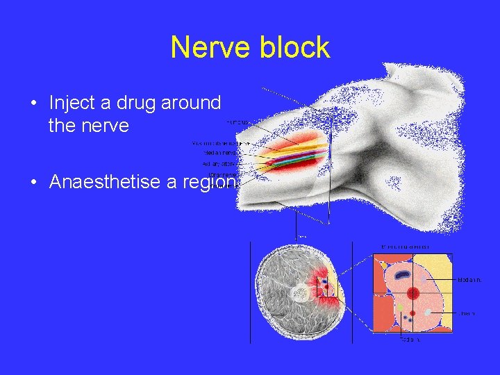 Nerve block • Inject a drug around the nerve • Anaesthetise a region 