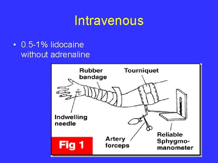 Intravenous • 0. 5 -1% lidocaine without adrenaline 