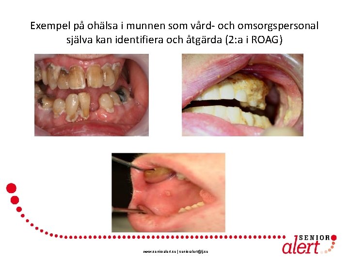 Exempel på ohälsa i munnen som vård- och omsorgspersonal själva kan identifiera och åtgärda
