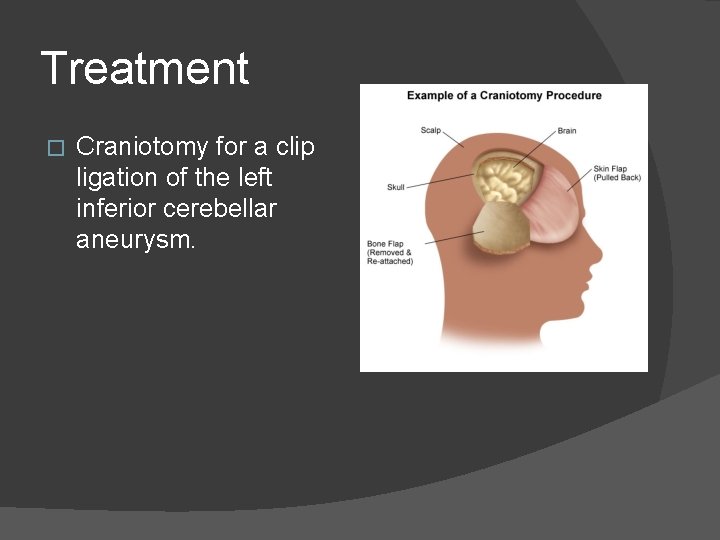 Treatment � Craniotomy for a clip ligation of the left inferior cerebellar aneurysm. 