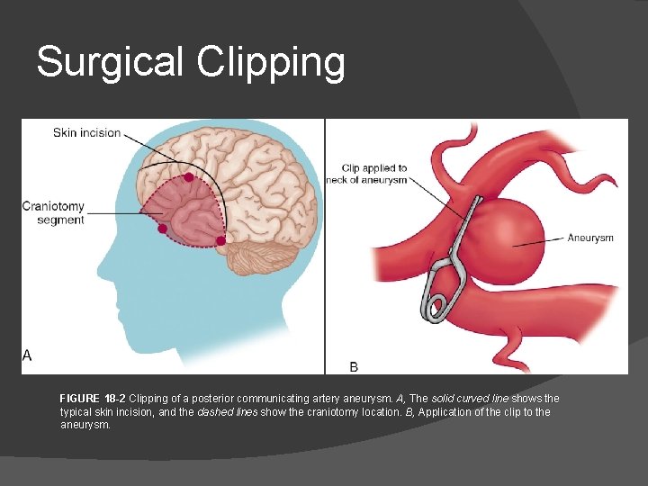 Surgical Clipping FIGURE 18 -2 Clipping of a posterior communicating artery aneurysm. A, The